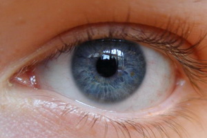 Виды астигматизма глаз