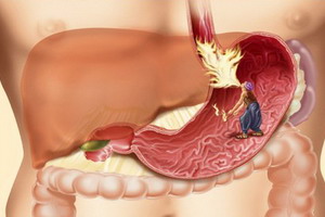 Болезни органов пищеварительного тракта человека