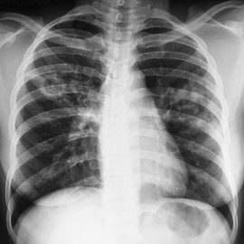 Туберкулез легких: основные формы, симптомы и лечение