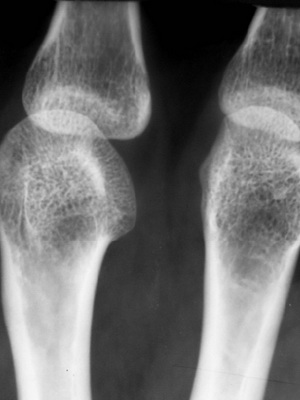 Заболевание остеопороз костей у женщин