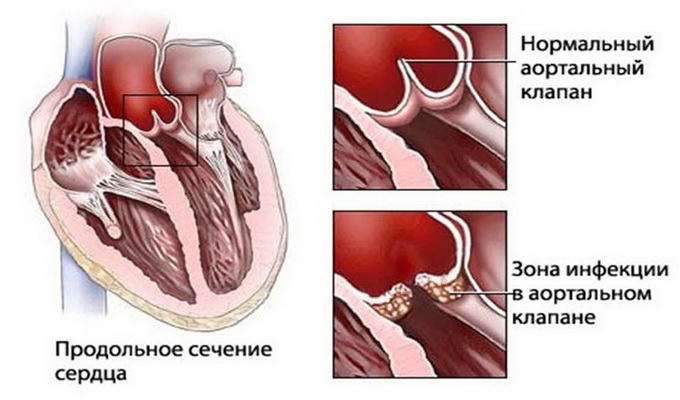 Ревматизм суставов и сердца – хроническая болезнь