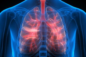 Острый и хронический диссеминированный (распространенный) туберкулез легких