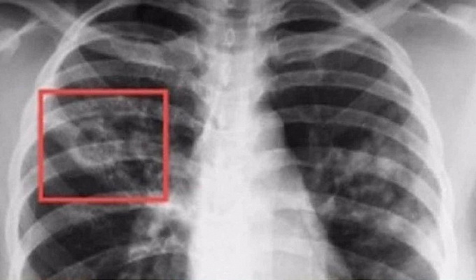 Очаговый туберкулёз легких – опасность рядом