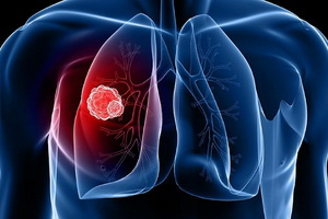 Туберкулема легких – инфекционная опухоль