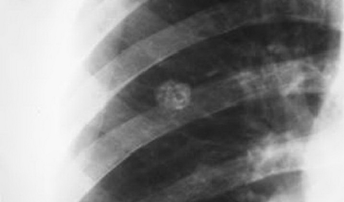 Туберкулема легких – инфекционная опухоль