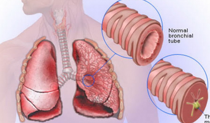 Кавернозная и фиброзно-кавернозная форма развития туберкулеза легких