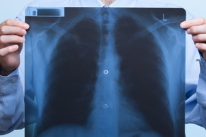 Цирротический туберкулез легких – неблагоприятный прогноз