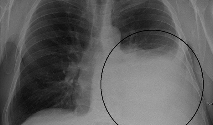 Туберкулёзный плеврит – воспаление оболочек легких