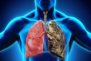 Клиническая медицинская классификация туберкулеза