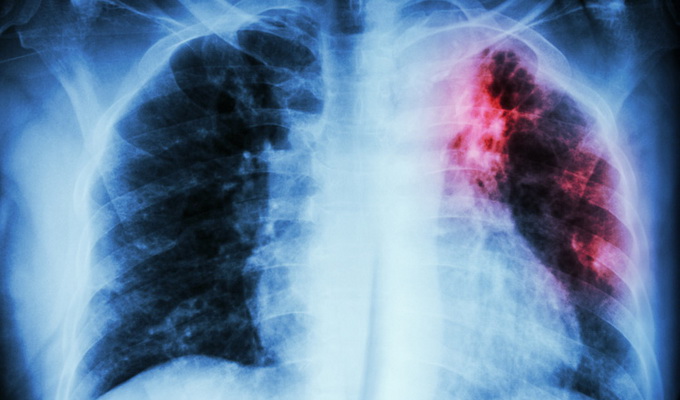 Клиническая медицинская классификация туберкулеза