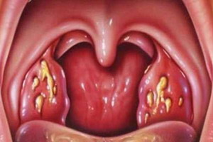 Чем можно обработать горло при гнойной ангине