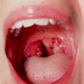 Чем обрабатывать рот при ангине