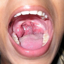 Чем обрабатывать полость рта при гнойной ангине