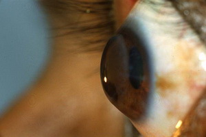 Кератоконус глаза лечение в домашних условиях