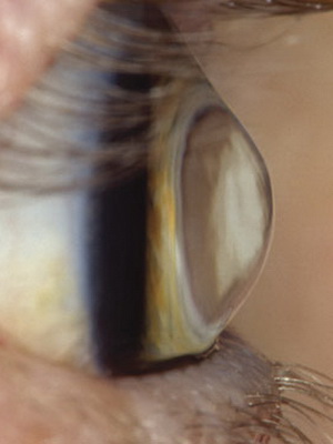 Как вылечить кератоконус глаз