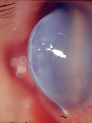 Кератоконус глаза лечение в домашних условиях thumbnail