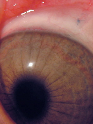 Кератоконус глаза лечение в домашних условиях