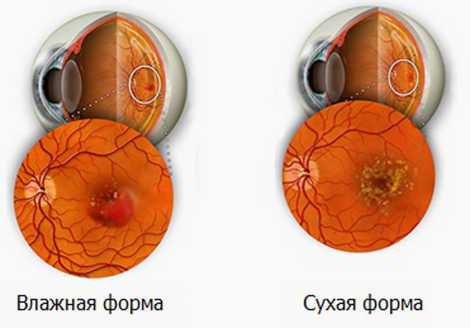 Макулодистрофия сетчатки глаза симптомы